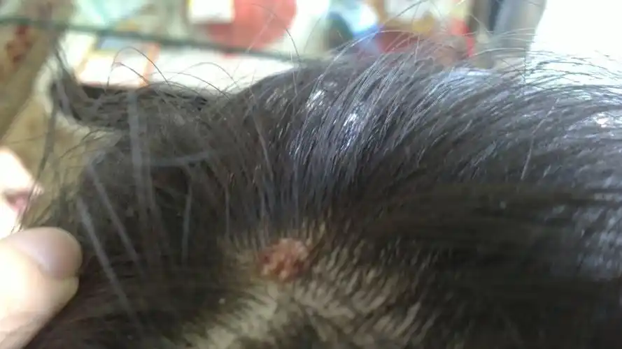 妈妈头皮上长的像一个小瘤似的,是凹凸不平的,麻烦大神们指导一下是