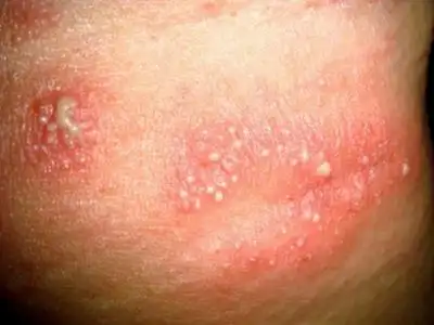 小孩脓疱病可以吃绿豆