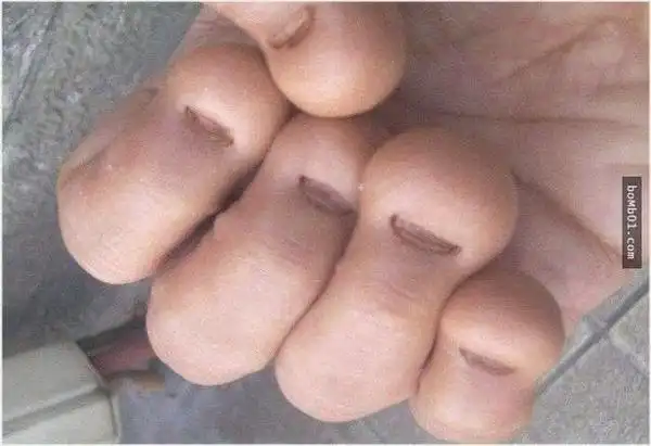 咬指甲(nailbitting)是指儿童反复出现的自主或不自主的啃咬手指甲