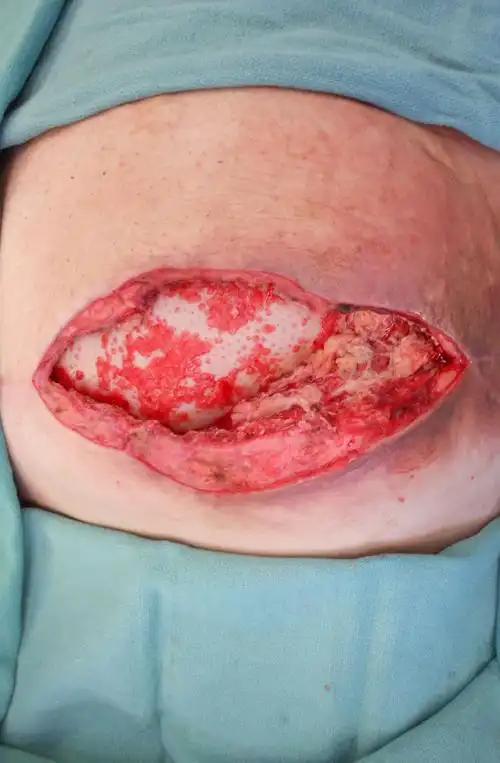 repair of giant subcostal hernia using porcine ace