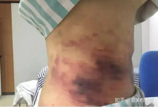 腹部吸脂需要多少费用?