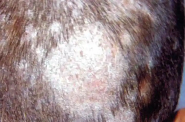 白色头癣是什么症状的图片白色头癣的症状图片白色头癣的症状的图片