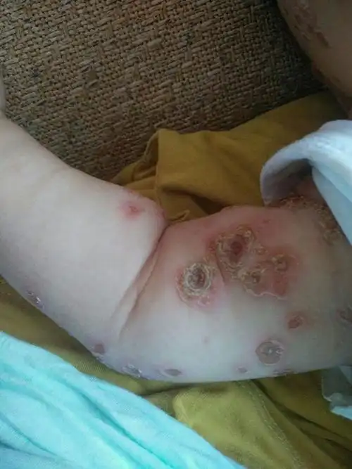 在女儿患脓包疮自愈的日子里