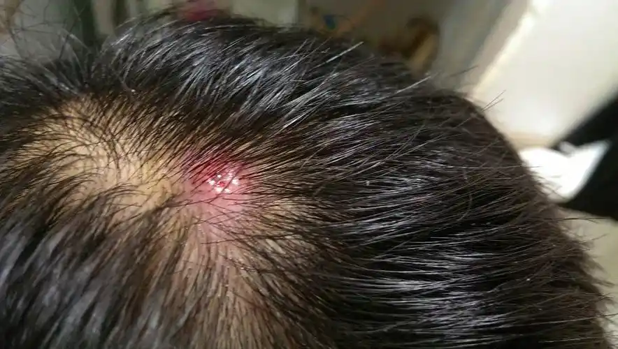 哪位懂皮肤科的医生请帮我看下,前四五天头上无缘