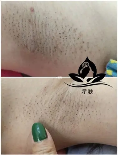 宝宝们别在自己刮毛了!_毛孔粗大_毛孔_美妆_个人护理