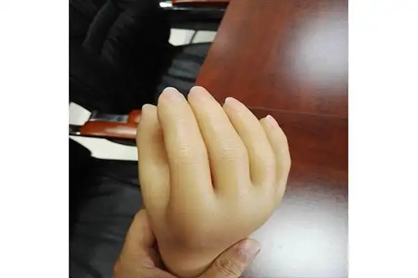 [揭秘]手指假肢不好用?是你方法没用对!