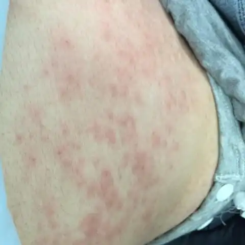 孕后期起了湿疹,有什么方法不痒嘛?