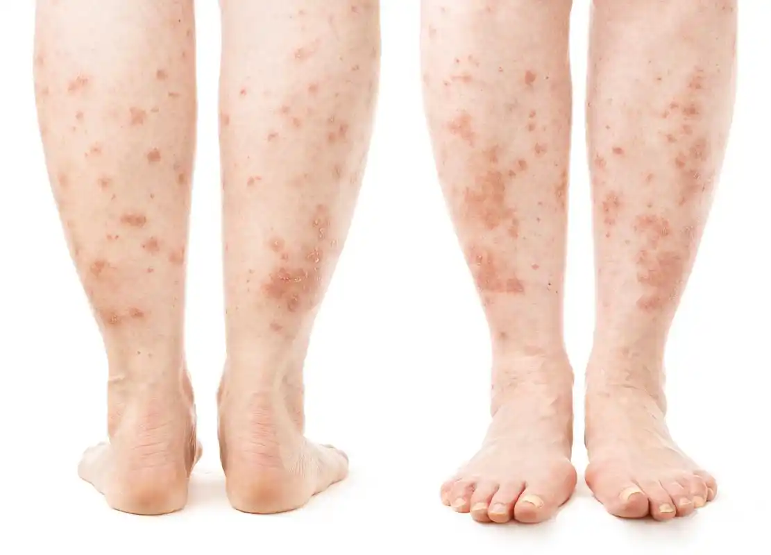 湿疹早期症状揭秘:如何辨识并及早防范皮肤问题?