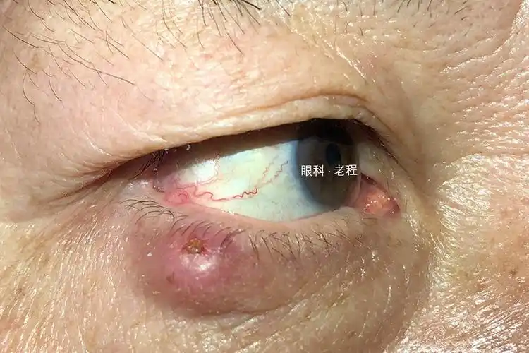 睑板腺囊肿(李汉生).jpg