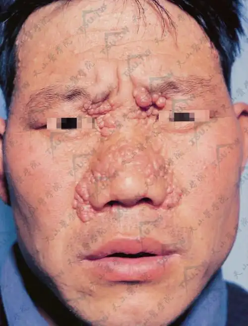 毛发上皮瘤(囊性腺样上皮瘤,trichoepithelioma)