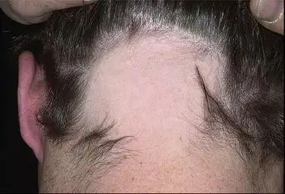 植发可以治疗疤痕性脱发吗?