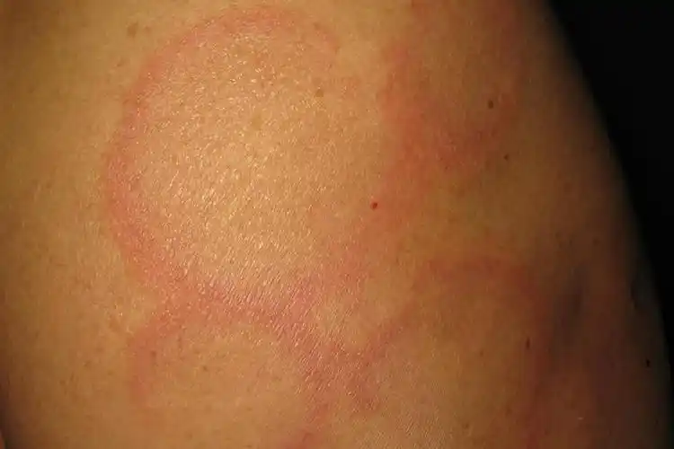 红斑狼疮根据临床表现可分为慢性皮肤型红斑狼疮,亚急性皮肤型红斑