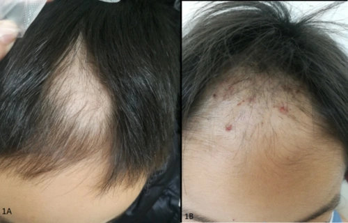 宝宝有苦说不出浅谈精神行为障碍性儿童皮肤病拔毛癖