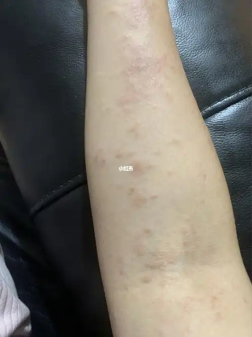 这到底是过敏还是湿疹?