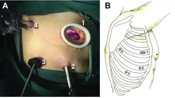 新型胸内 t 形胃食管吻合术安全易行