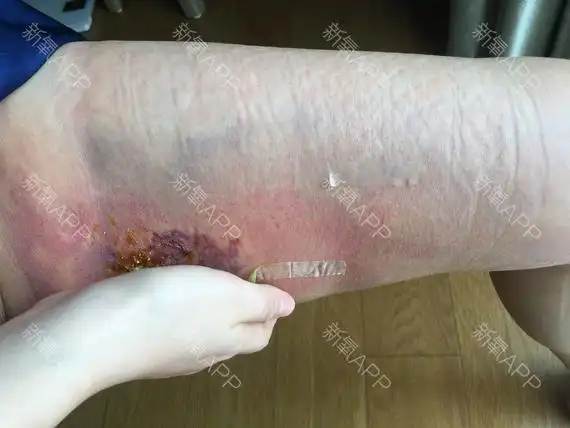 有没有抽脂过的,这是怎么回事