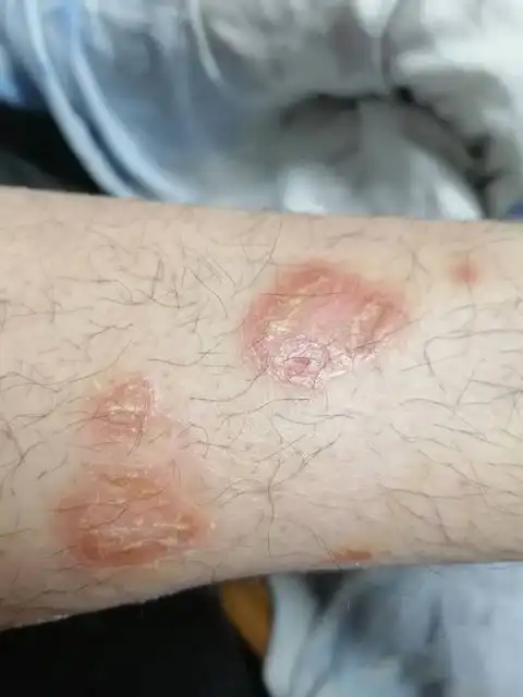 身上起皮屑图片_银屑病求医网