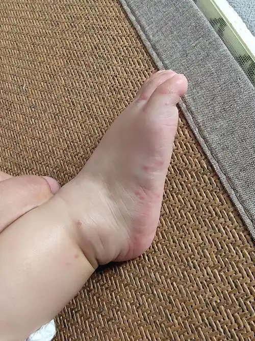 宝宝脚上长的这是啥东西?涂药膏也不见好