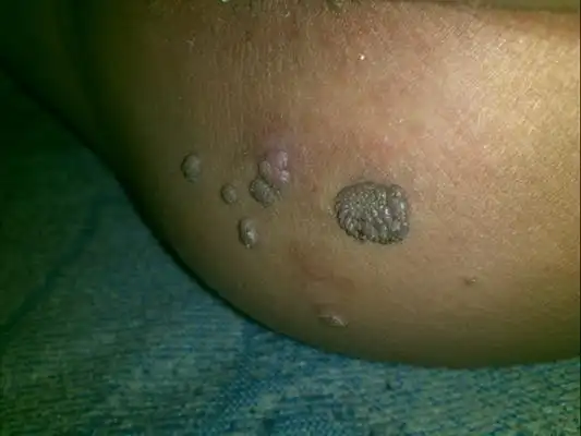 疥疮图片_疥疮症状表现图片大全_有来医生