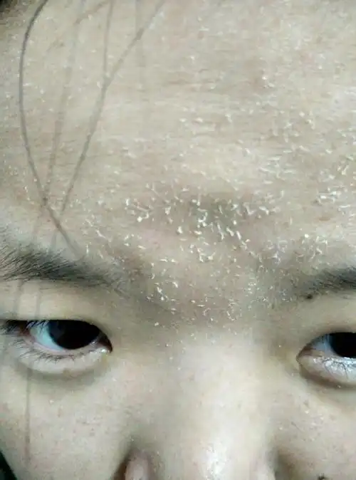 现在冬天,每一次洗完脸之后大概五分钟额头包括脸上会