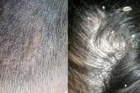 头皮癣图片展示 教你几招轻松治疗