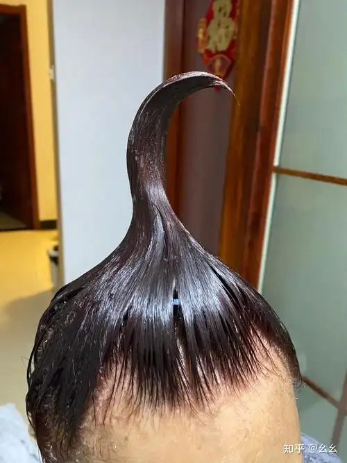 见过的最大头皮屑多大