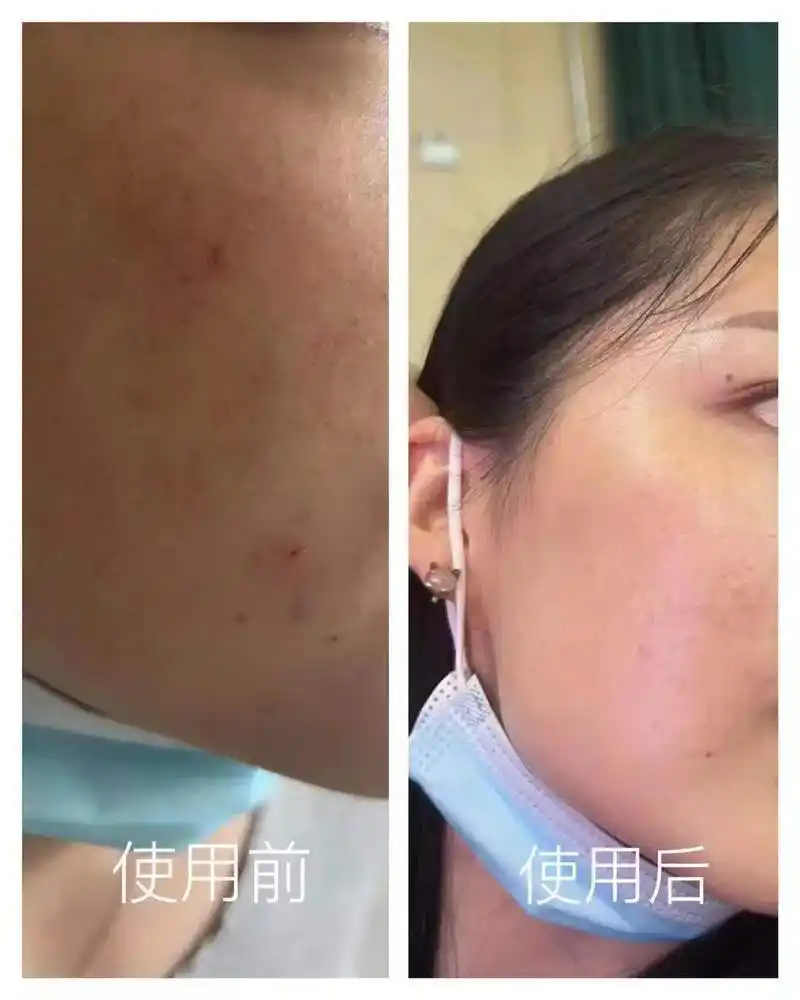 小姐姐皮肤敏感脆弱时不时泛红瘙痒还有小闭口