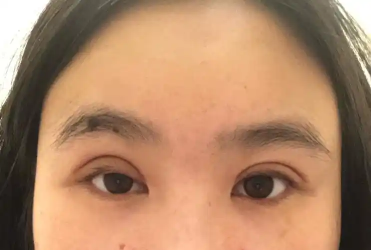 拉完双眼皮右眼做了上眼提肌现在天了两只眼睛和双眼皮都不一样大是