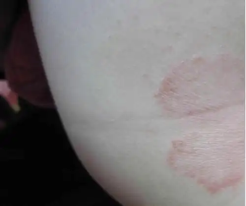 从小就常常起湿疹,各种药膏涂了很多,涂几天好了,过两天又起,屁股也是