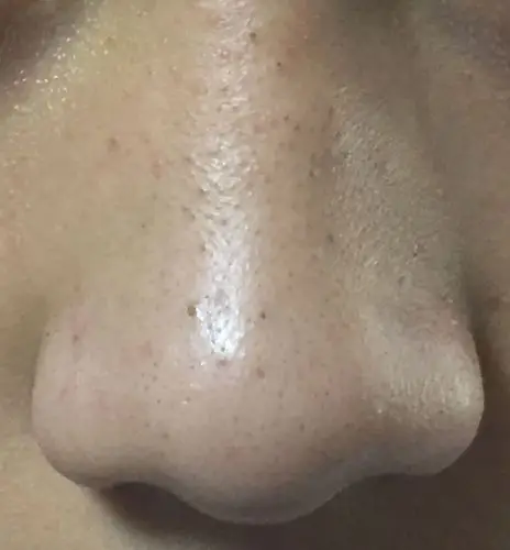 这个是黑头吗?还是由于螨虫引起的白头粉刺?该怎么治疗?