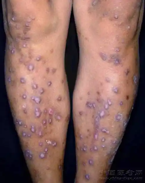 史上最全的皮肤病图谱来了(修订版)!