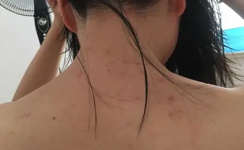 背上胸口上全是这样的痘痘,怎么能治好啊,不疼不痒的,吃了几副中药