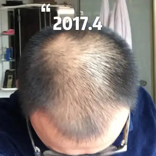 扛秃5年又寸头了