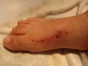 解梦之梦见自己的脚出血