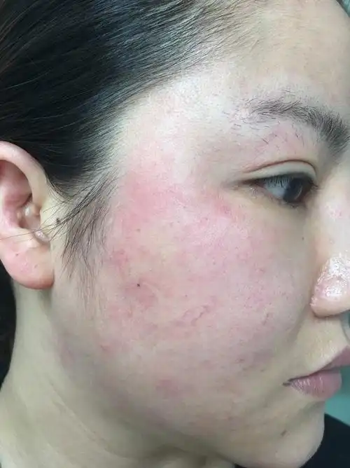 我的皮肤一直都处于t区油脸颊易过敏的状态,不过一般过敏也就脸