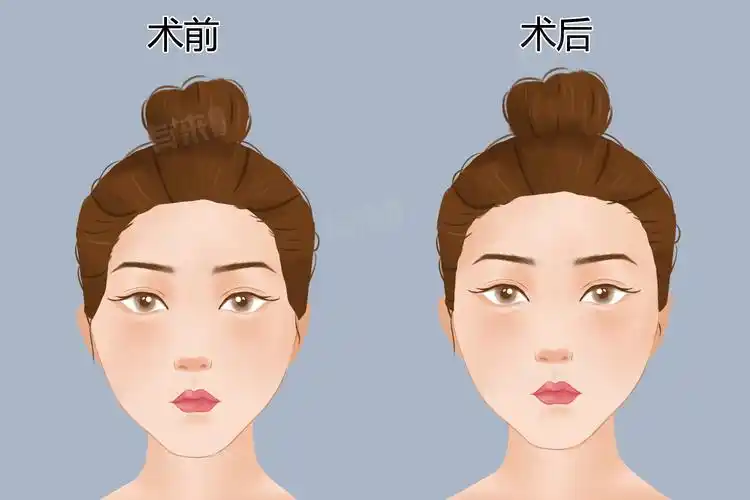 脂肪填充10天就快没了