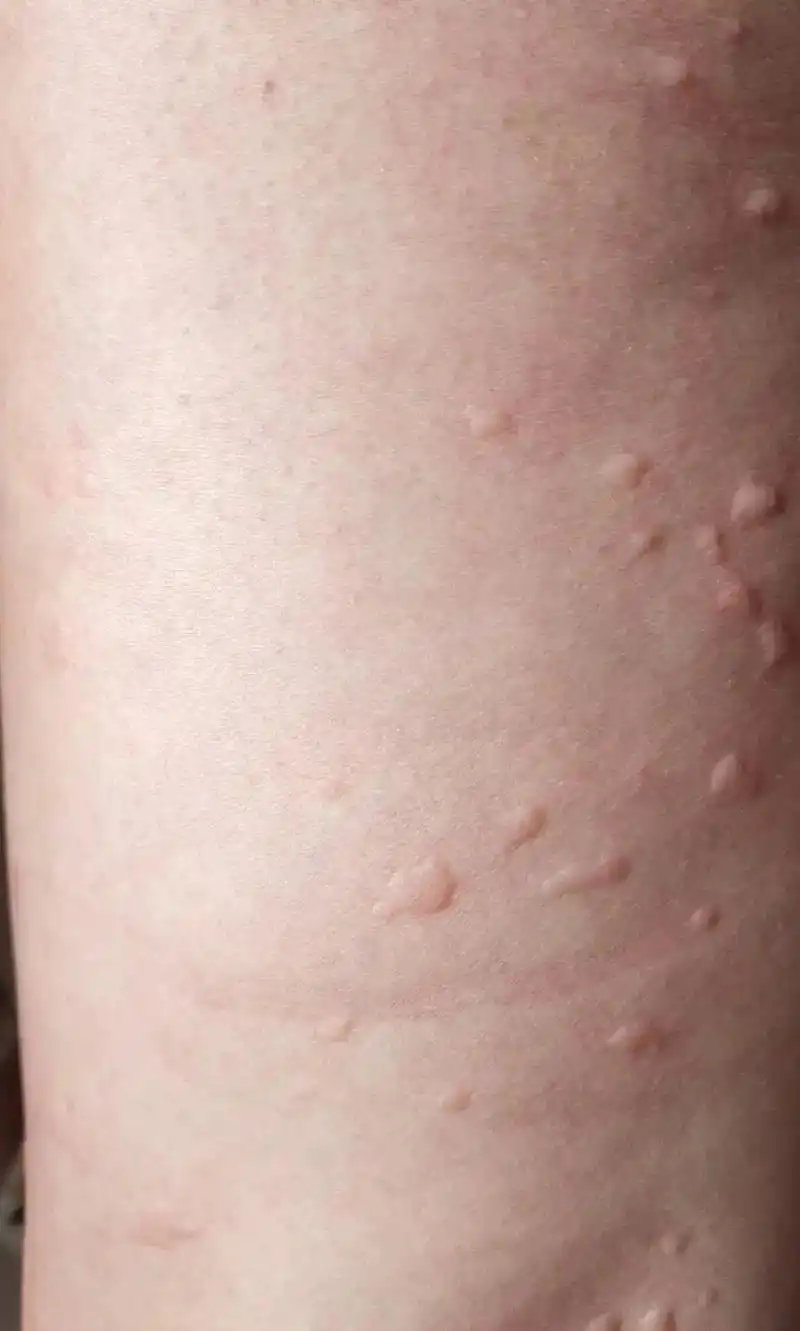 请问夏天来了谁对你最好,蚊子呗,动不动就给我发个红包,不要硬 - 抖音