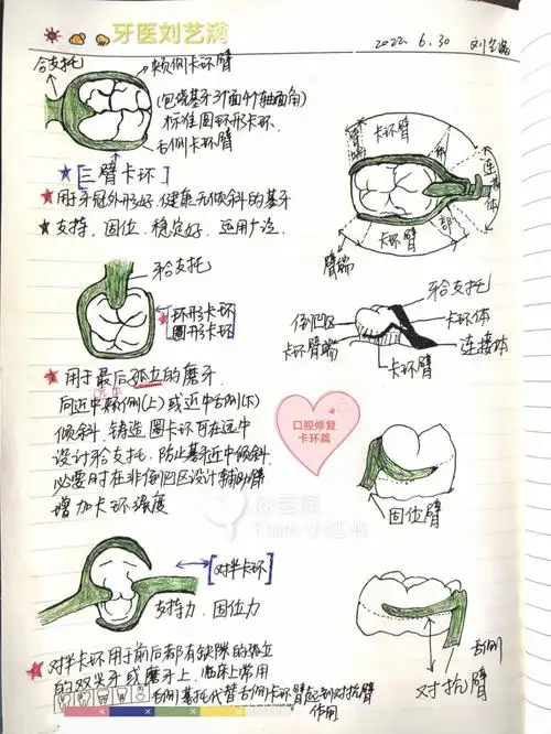 口腔修复笔记卡环篇06