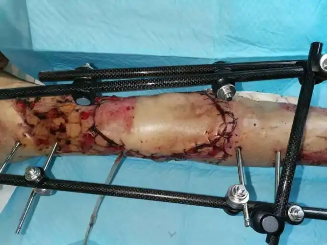 男子面临截肢风险医生攻坚克难三次手术后保肢成功