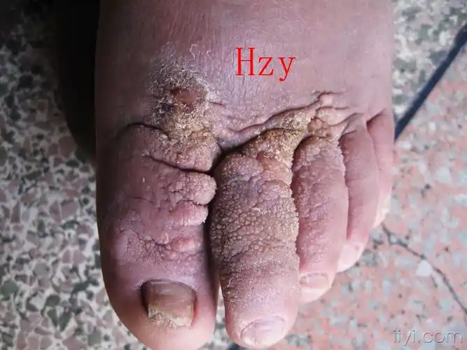 这一双脚是一个病人的.公布答案:慢性淋巴水肿