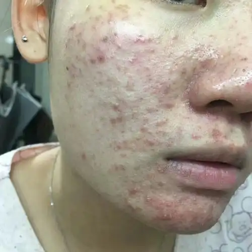 过敏激素皮炎红血丝的全面解析——姿美媛中药问题皮肤修复