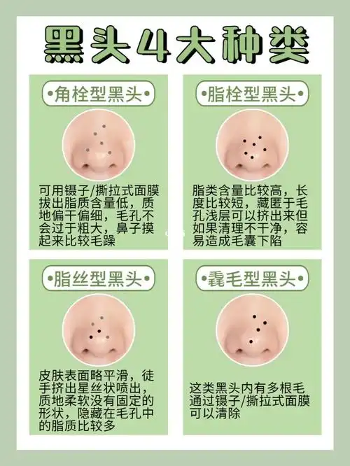 你属于哪种黑头类型?来抄解决方案!