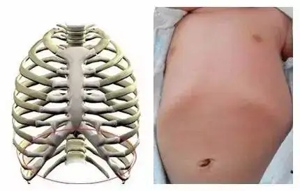 孩子肋骨外翻是不是佝偻病该怎么办