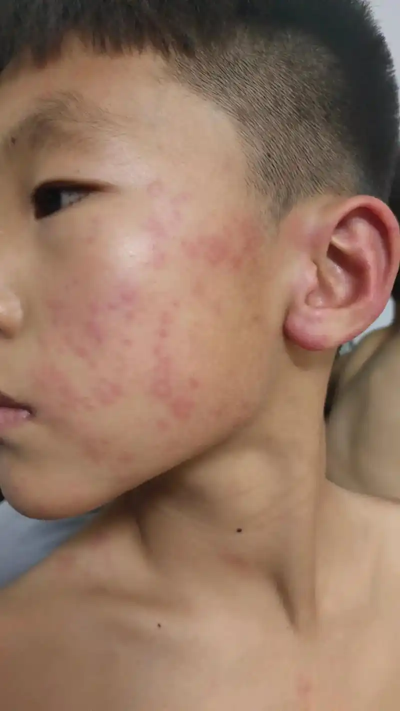 老师打电话让去接孩,从学接回家孩就成这样了,医生说是过敏,两 - 抖音