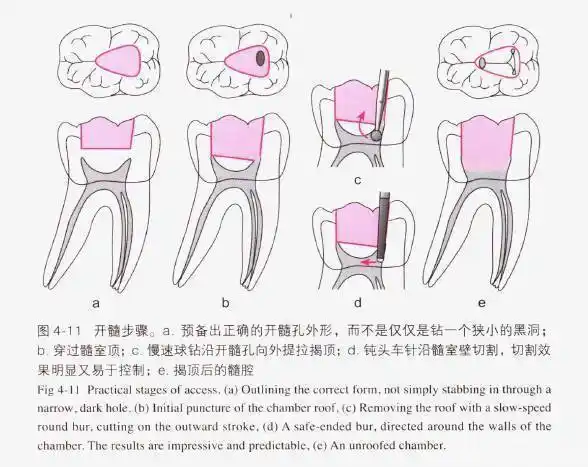 标准开髓口形态
