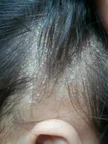 2岁宝宝头上长像头皮屑一样的东西