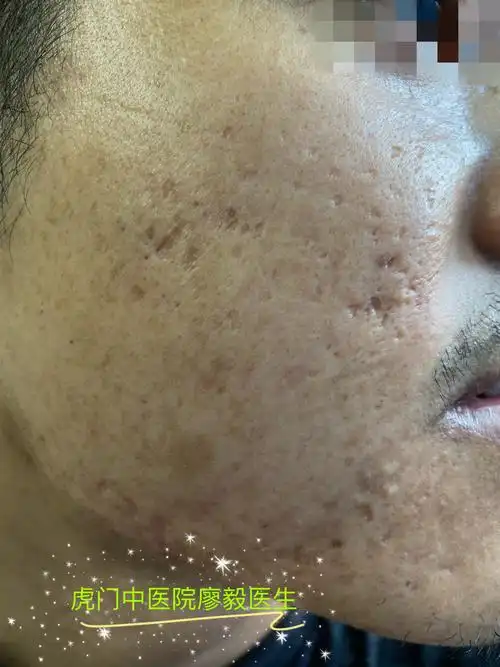 治疗凹陷性痘坑的金标准是——co2点阵激光_痤疮_痤疮治疗方式 - 好