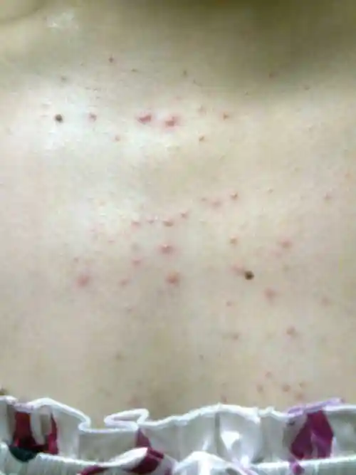 忽然胸前长了很多的痘痘?