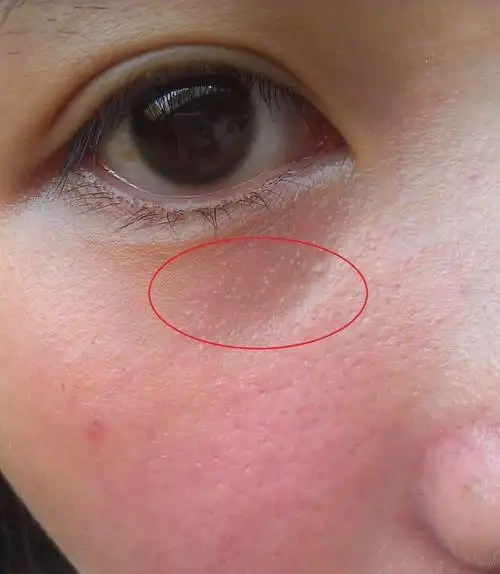 不能正常排至表皮,从而堆积与皮肤内形成的颗粒