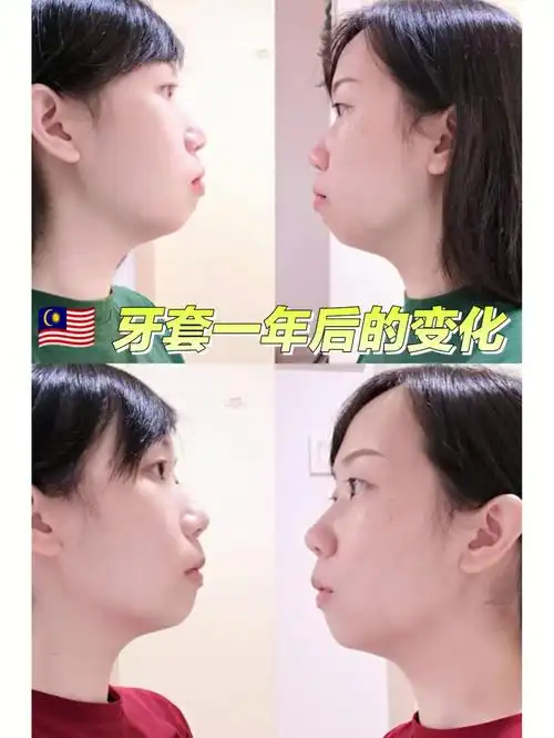 牙套一年后的变化